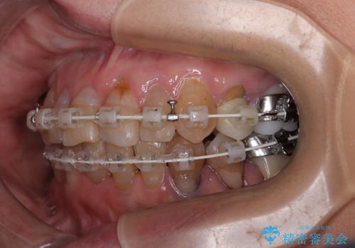 長年気になっていた前歯 矯正治療と補綴治療による審美歯科治療の治療中