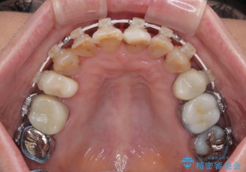 長年気になっていた前歯 矯正治療と補綴治療による審美歯科治療の治療中