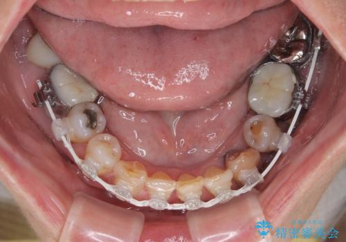 長年気になっていた前歯 矯正治療と補綴治療による審美歯科治療の治療中