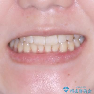 気になる前歯と咬み合わせを改善 インビザライン・モデレートの治療後(顔貌)