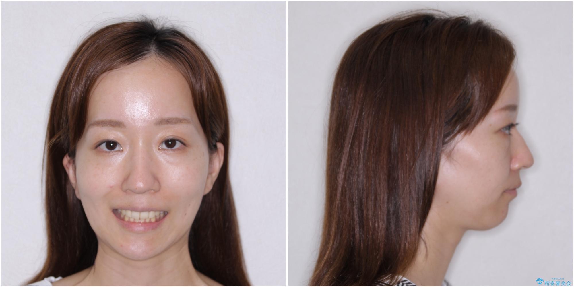 【モニター】唇が閉じにくい ワイヤー装置での抜歯矯正の治療後(顔貌)