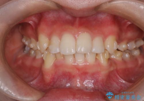 重度の歯のがたつきを、目立たない矯正と抜歯で根本改善の治療中