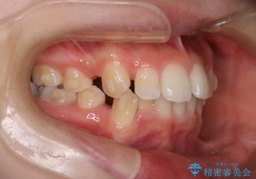 重度の歯のがたつきを、目立たない矯正と抜歯で根本改善の治療中