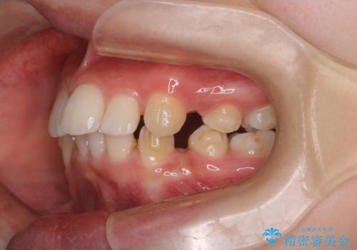 重度の歯のがたつきを、目立たない矯正と抜歯で根本改善の治療中