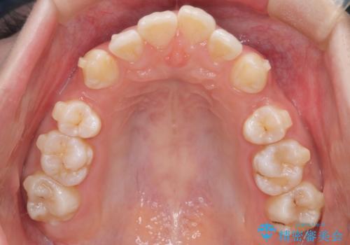 重度の歯のがたつきを、目立たない矯正と抜歯で根本改善の治療中