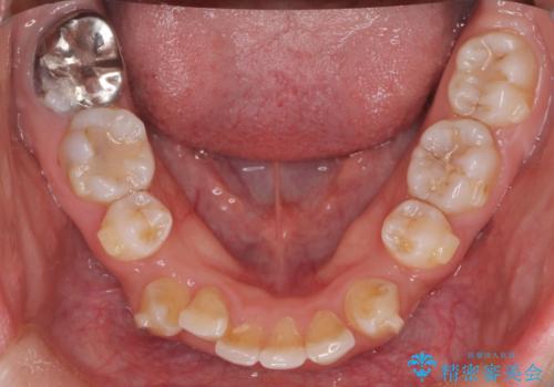 重度の歯のがたつきを、目立たない矯正と抜歯で根本改善の治療中