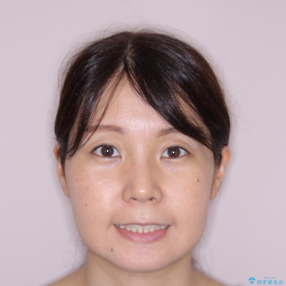【モニター】閉じにくい前歯とクロスバイト ワイヤー装置での抜歯矯正の治療後(顔貌)