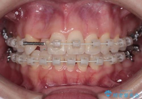 【審美装置】非抜歯矯正で八重歯改善!の治療中