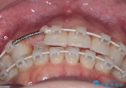 【審美装置】非抜歯矯正で八重歯改善!の治療中