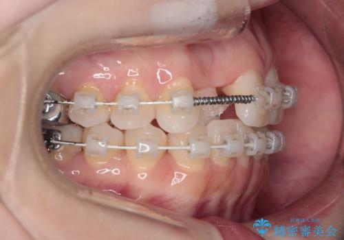 【審美装置】非抜歯矯正で八重歯改善!の治療中