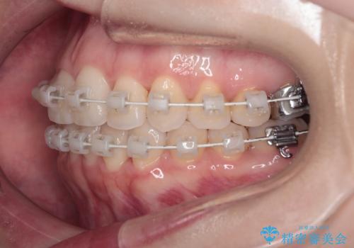 【審美装置】非抜歯矯正で八重歯改善!の治療中