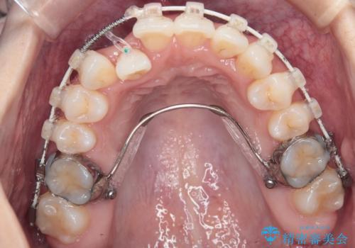 【審美装置】非抜歯矯正で八重歯改善!の治療中