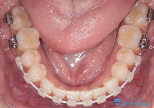 【審美装置】非抜歯矯正で八重歯改善!の治療中