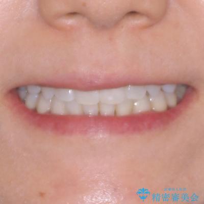 クロスバイトを治したい インビザラインによる矯正治療の治療後(顔貌)
