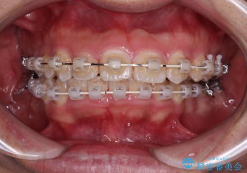左右に顎がずれた咬み合わせ ワイヤー矯正で咬み合わせを改善の治療中