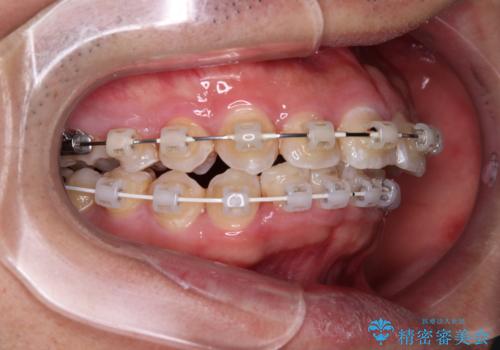 左右に顎がずれた咬み合わせ　ワイヤー矯正で咬み合わせを改善の治療中