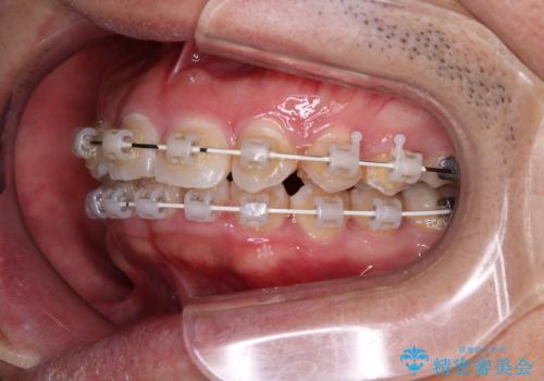 左右に顎がずれた咬み合わせ　ワイヤー矯正で咬み合わせを改善の治療中