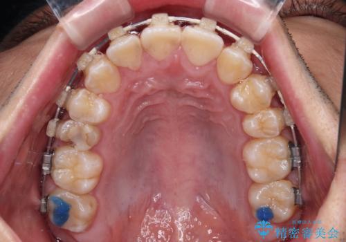 左右に顎がずれた咬み合わせ ワイヤー矯正で咬み合わせを改善の治療中