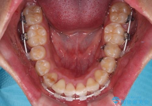 左右に顎がずれた咬み合わせ ワイヤー矯正で咬み合わせを改善の治療中