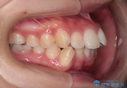 重度の歯のがたつきを、目立たない矯正と抜歯で根本改善の治療前