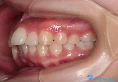 重度の歯のがたつきを、目立たない矯正と抜歯で根本改善の治療前