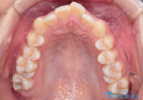重度の歯のがたつきを、目立たない矯正と抜歯で根本改善の治療前