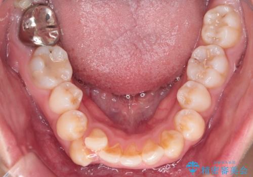 重度の歯のがたつきを、目立たない矯正と抜歯で根本改善の治療前
