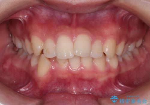 重度の歯のがたつきを、目立たない矯正と抜歯で根本改善の治療前