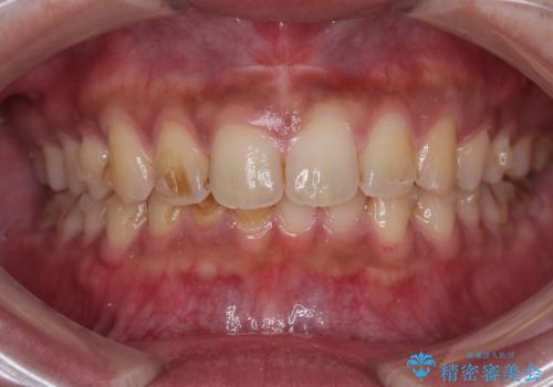 目立たない矯正で正中離開と下の前歯のデコボコを改善|インビザラインによる治療症例の治療中