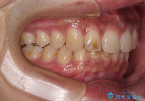 目立たない矯正で正中離開と下の前歯のデコボコを改善|インビザラインによる治療症例の治療中