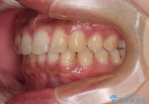 目立たない矯正で正中離開と下の前歯のデコボコを改善|インビザラインによる治療症例の治療中