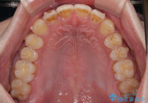 目立たない矯正で正中離開と下の前歯のデコボコを改善|インビザラインによる治療症例の治療中