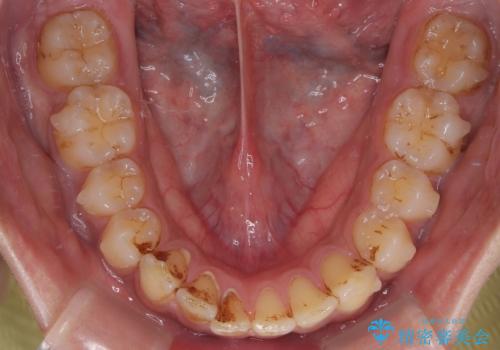 目立たない矯正で正中離開と下の前歯のデコボコを改善|インビザラインによる治療症例の治療中