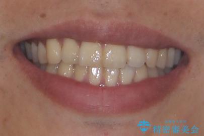 矯正後の後戻りをインビザラインライトで再治療|目立たない矯正の症例紹介の治療前(顔貌)