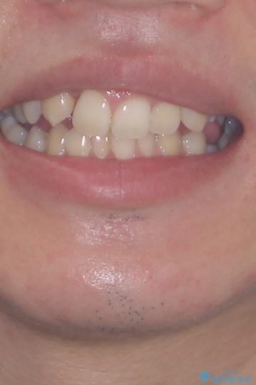 抜歯矯正で叢生と正中のずれを改善|審美装置による矯正症例の治療前(顔貌)
