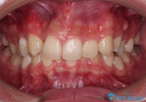 抜歯矯正で叢生と正中のずれを改善|審美装置による矯正症例の症例 治療前
