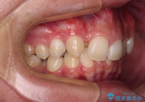 抜歯矯正で叢生と正中のずれを改善|審美装置による矯正症例の治療前