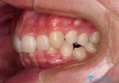 抜歯矯正で叢生と正中のずれを改善|審美装置による矯正症例の治療前