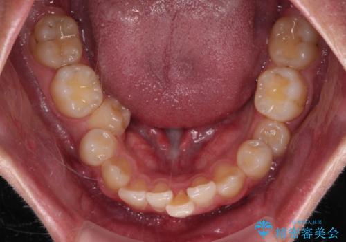 抜歯矯正で叢生と正中のずれを改善|審美装置による矯正症例の治療前