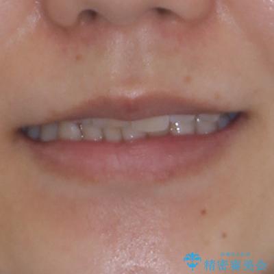 気になる前歯と咬み合わせを改善 インビザライン・モデレートの治療前(顔貌)