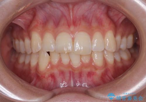 気になる前歯と咬み合わせを改善 インビザライン・モデレートの治療前