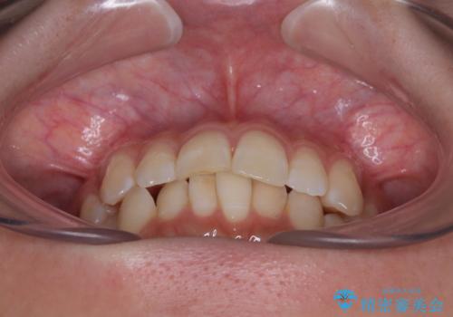 気になる前歯と咬み合わせを改善　インビザライン・モデレート