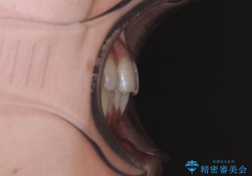 気になる前歯と咬み合わせを改善 インビザライン・モデレートの治療前