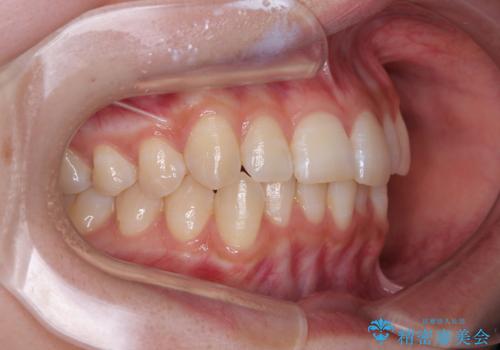 気になる前歯と咬み合わせを改善　インビザライン・モデレートの治療前