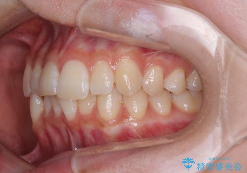 気になる前歯と咬み合わせを改善 インビザライン・モデレートの治療前