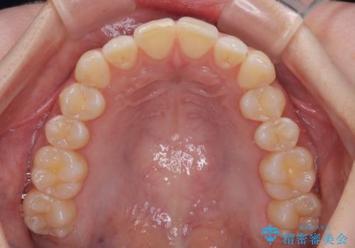 気になる前歯と咬み合わせを改善 インビザライン・モデレートの治療前