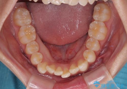 気になる前歯と咬み合わせを改善 インビザライン・モデレートの治療前