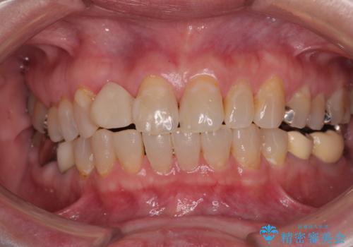 新幹線&飛行機で通院　最小限の通院で前歯のインプラント治療の治療前