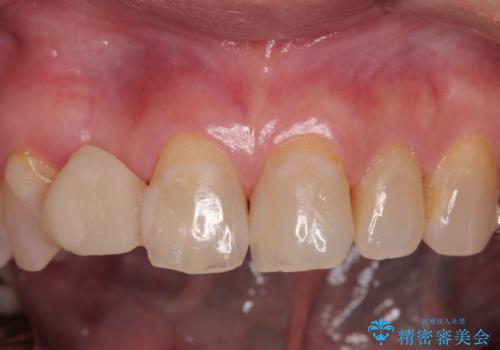 新幹線&飛行機で通院　最小限の通院で前歯のインプラント治療の治療前