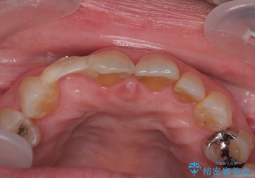 新幹線&飛行機で通院　最小限の通院で前歯のインプラント治療の治療前